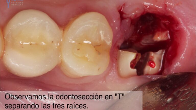 Costo de extracción de una muela rota: ¿Cuánto cuesta?