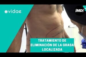 Mesoterapia: la clave para quemar grasa