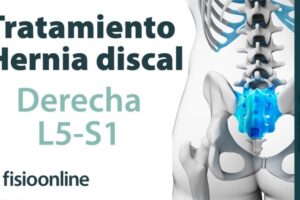 Tratamiento óptimo para hernia discal L5 S1