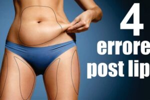 Mi experiencia con la liposucción: ¿Por qué aún me veo gorda?