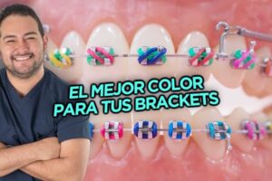 Descubre el color de brackets ideal para la mujer