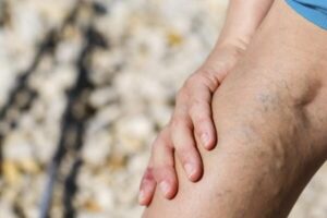 Eliminación efectiva de venas varicosas en las piernas
