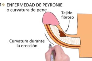 Desmantelando la placa de Peyronie: Métodos efectivos y seguros